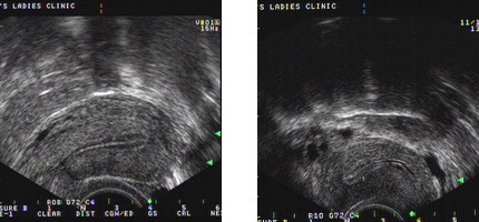 e-stork 子宮內膜超音波